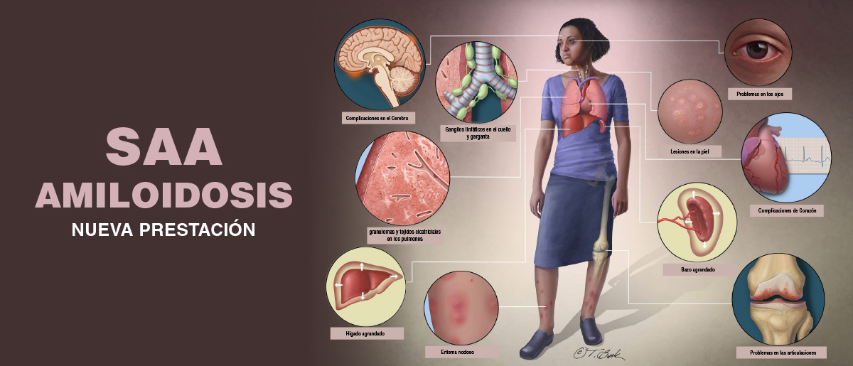 SAA AMILOIDOSIS Nueva Prestaci n MANLAB